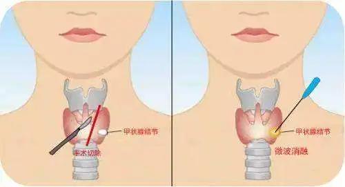 甲状腺结节注意事项,甲状腺结节的饮食方面应注意事项,甲状腺结节患者饮食注意事项