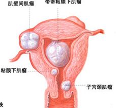 直肠息肉灌肠注意事项