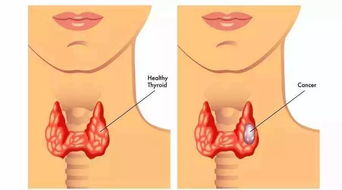 甲状腺结节要注意事项